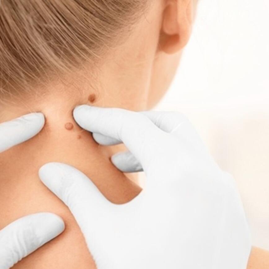 Mit kell tudni a szemölcsök eltávolításáról, lefagyasztásáról?